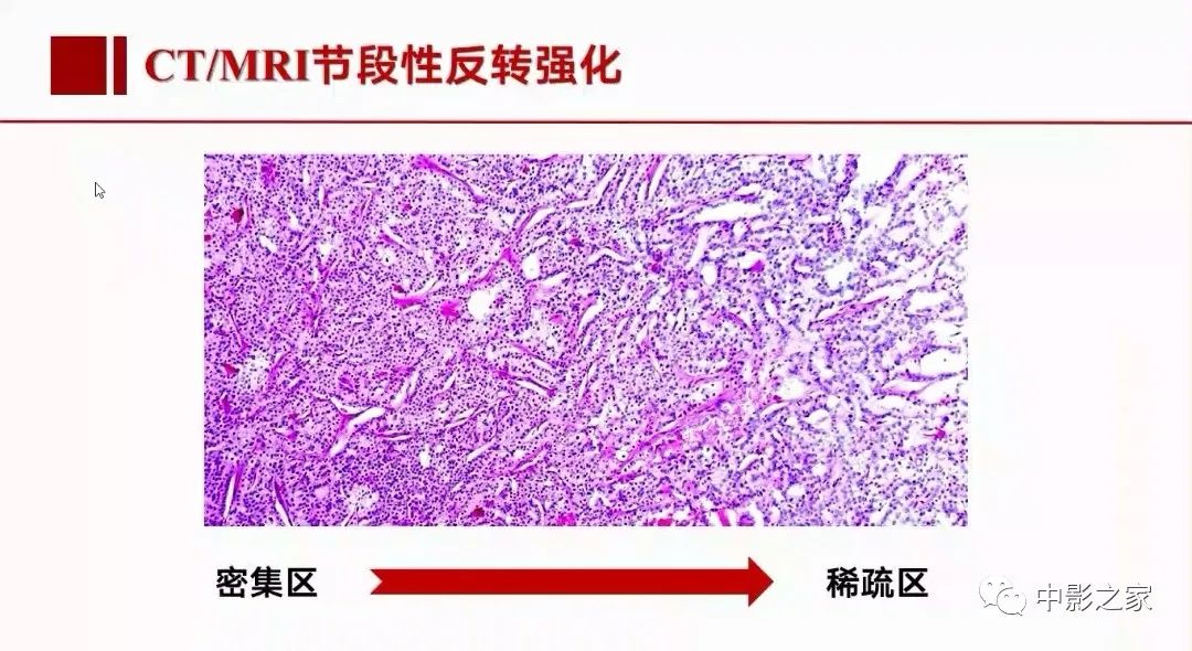 【PPT】肾嫌色细胞癌影像诊断、鉴别、分级与预后评估-29