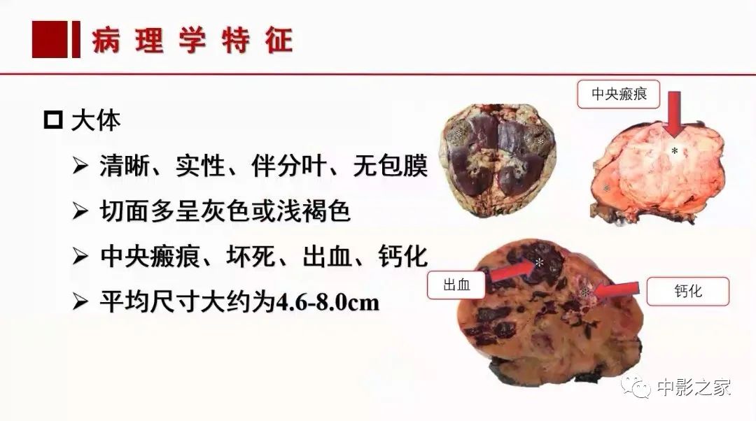 【PPT】肾嫌色细胞癌影像诊断、鉴别、分级与预后评估-12