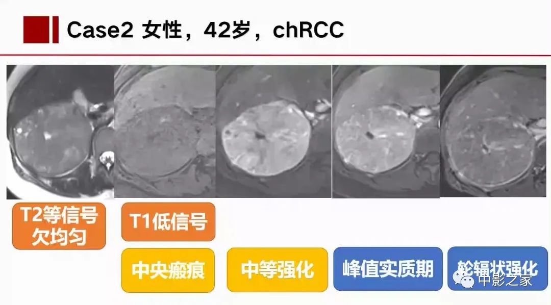 【PPT】肾嫌色细胞癌影像诊断、鉴别、分级与预后评估-27