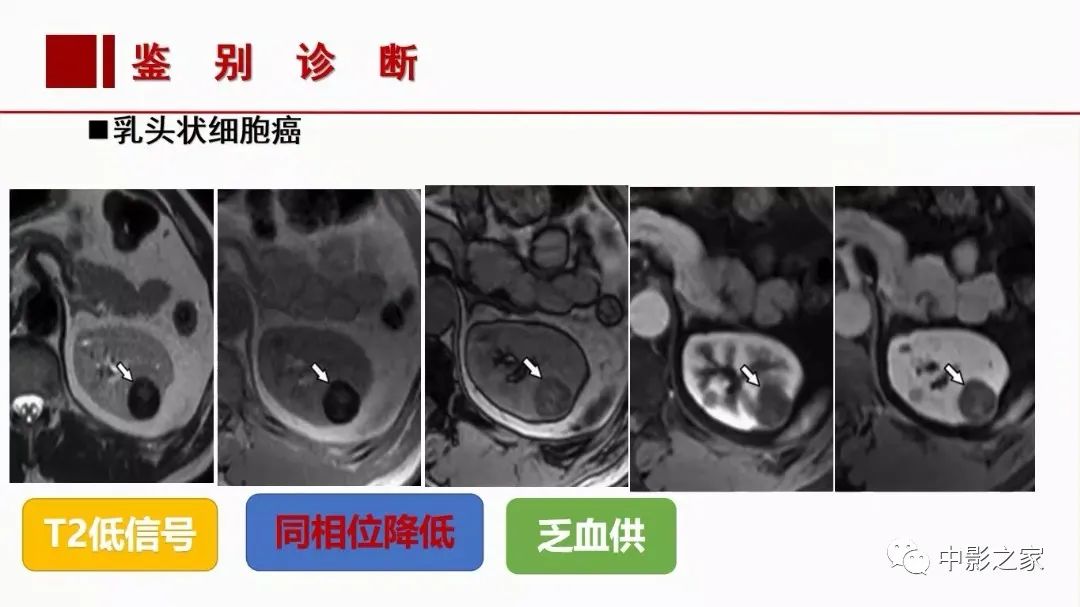 【PPT】肾嫌色细胞癌影像诊断、鉴别、分级与预后评估-35