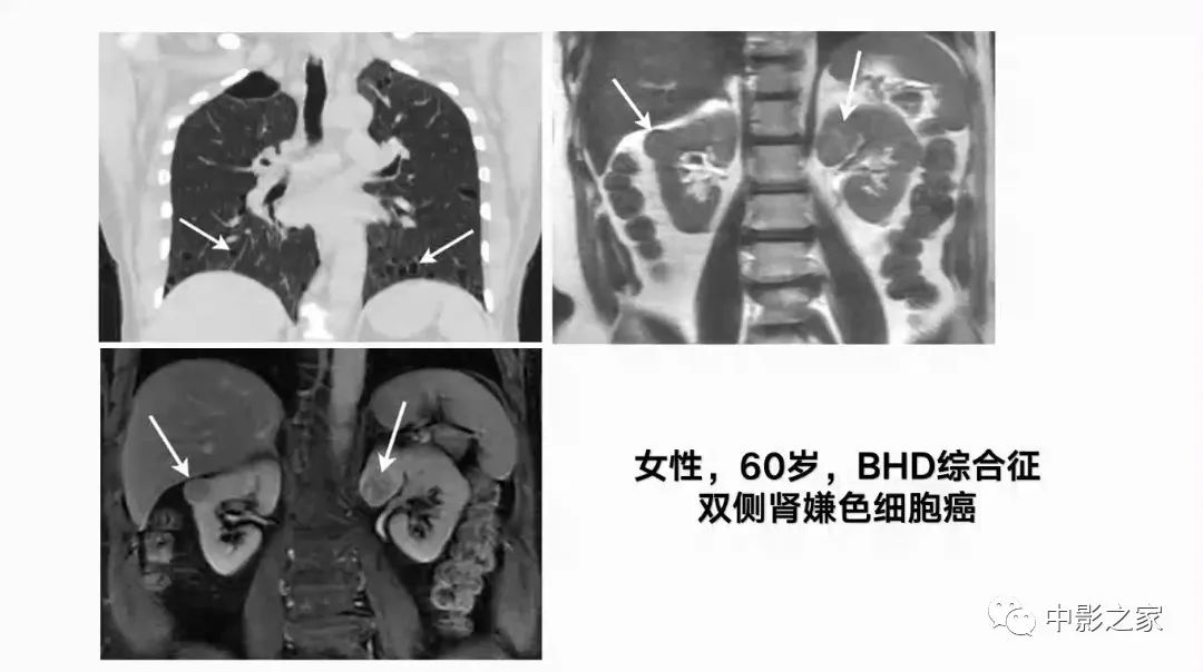 【PPT】肾嫌色细胞癌影像诊断、鉴别、分级与预后评估-8