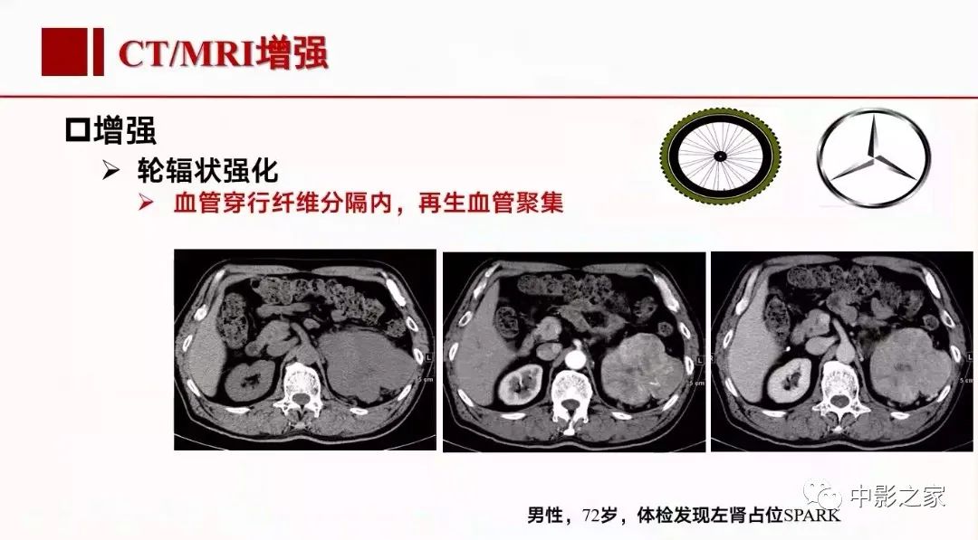 【PPT】肾嫌色细胞癌影像诊断、鉴别、分级与预后评估-26