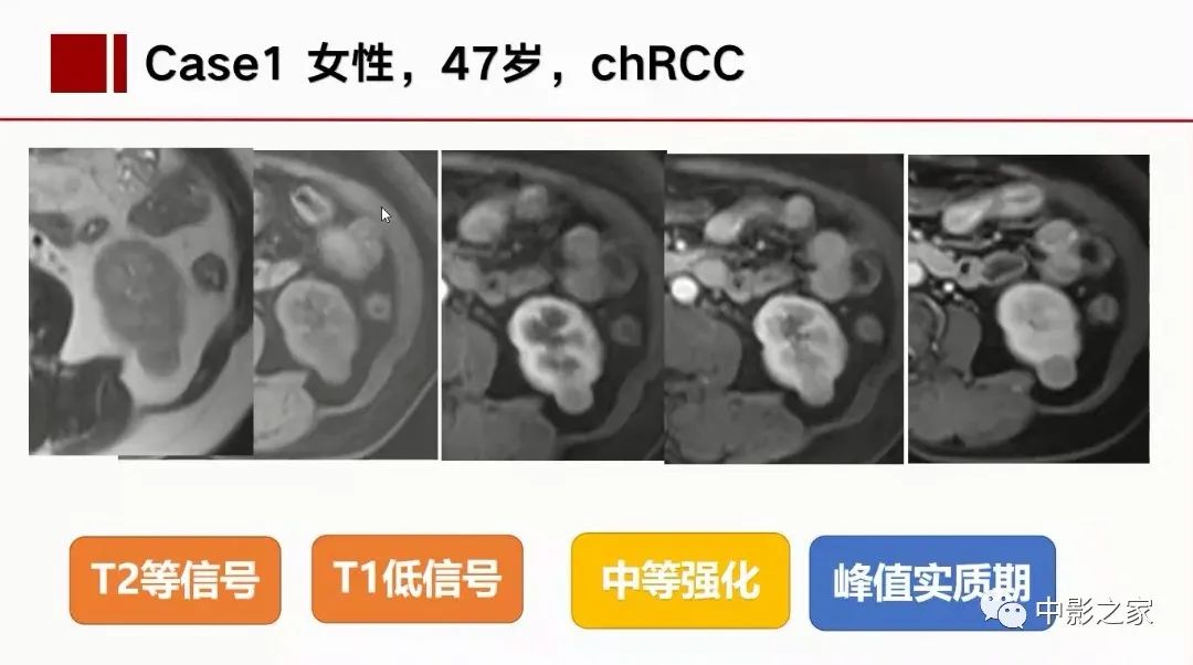 【PPT】肾嫌色细胞癌影像诊断、鉴别、分级与预后评估-25