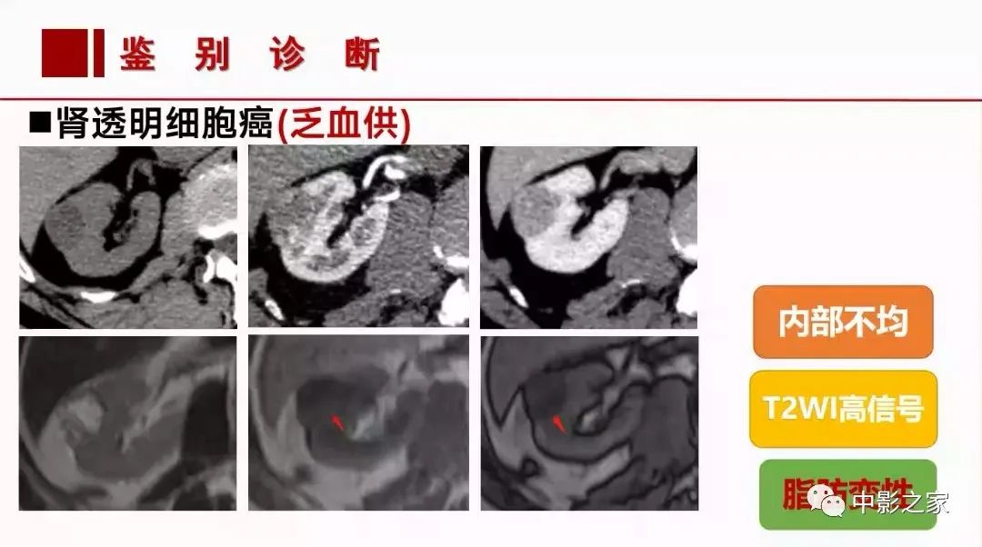 【PPT】肾嫌色细胞癌影像诊断、鉴别、分级与预后评估-33