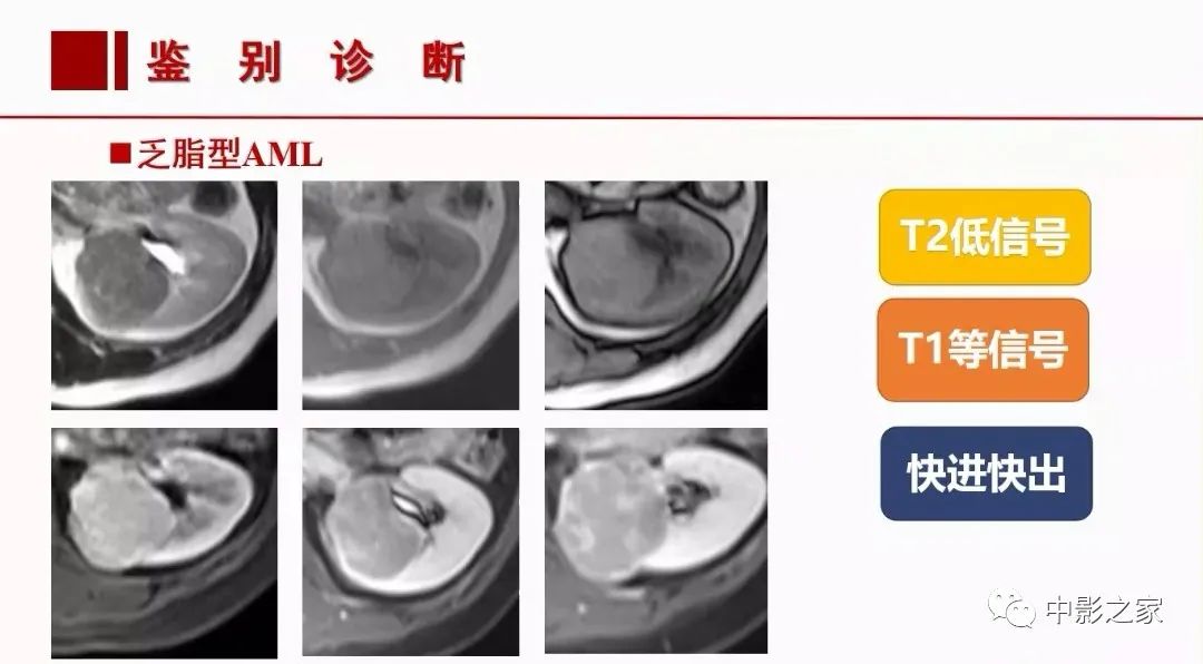 【PPT】肾嫌色细胞癌影像诊断、鉴别、分级与预后评估-37