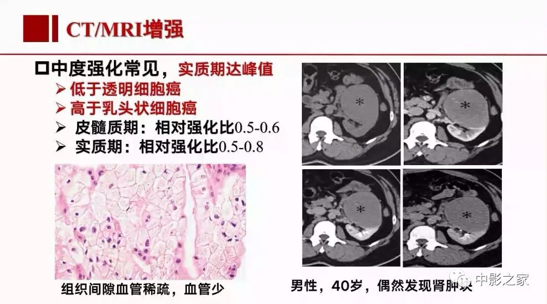 【PPT】肾嫌色细胞癌影像诊断、鉴别、分级与预后评估-24