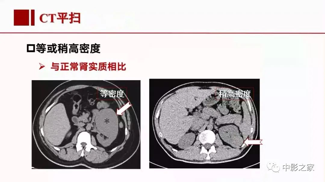 【PPT】肾嫌色细胞癌影像诊断、鉴别、分级与预后评估-18