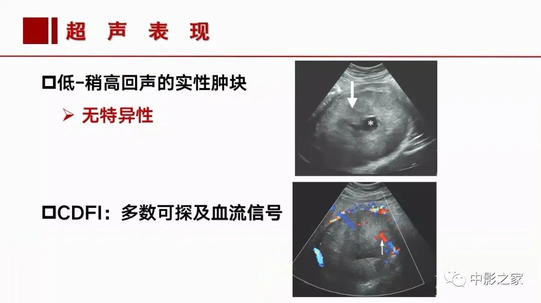 【PPT】肾嫌色细胞癌影像诊断、鉴别、分级与预后评估-17