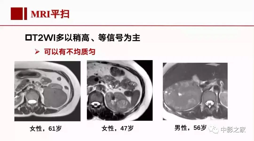 【PPT】肾嫌色细胞癌影像诊断、鉴别、分级与预后评估-22