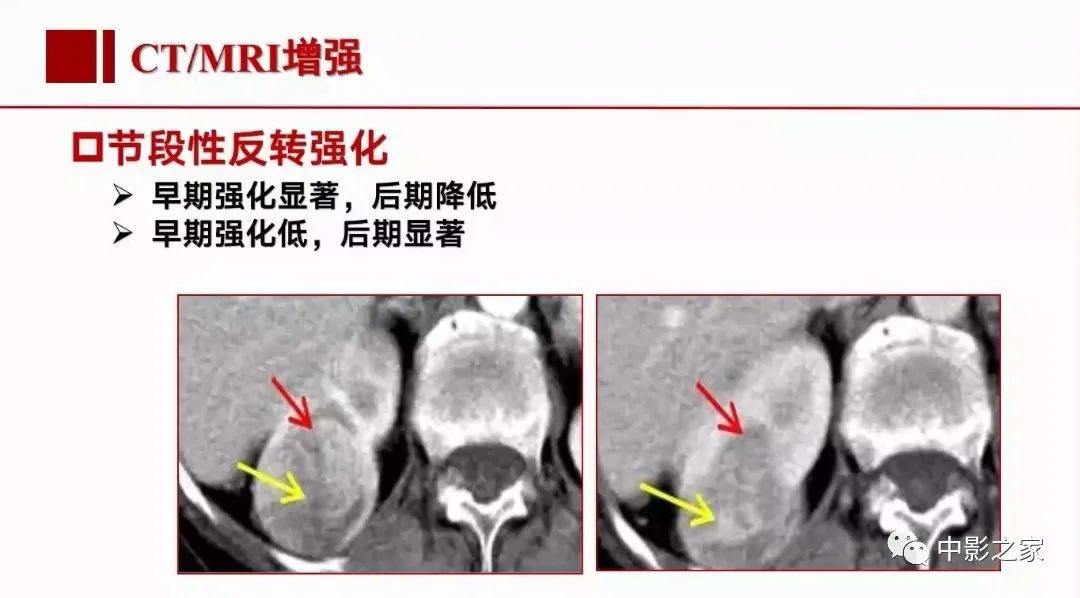 【PPT】肾嫌色细胞癌影像诊断、鉴别、分级与预后评估-28