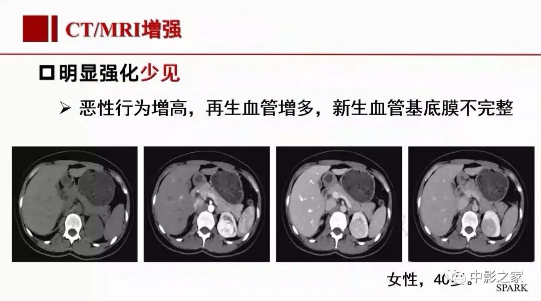 【PPT】肾嫌色细胞癌影像诊断、鉴别、分级与预后评估-30