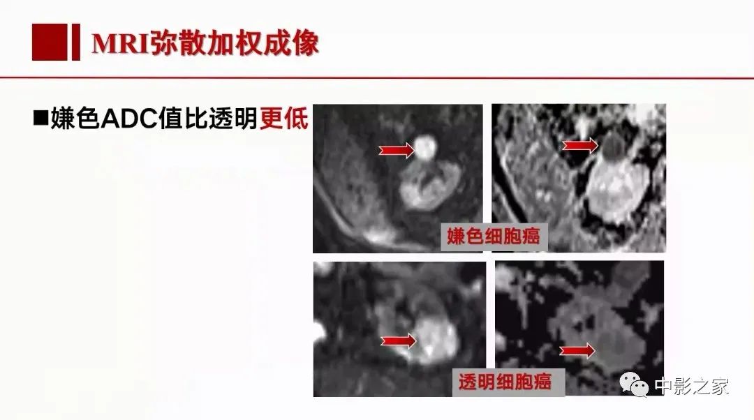【PPT】肾嫌色细胞癌影像诊断、鉴别、分级与预后评估-23