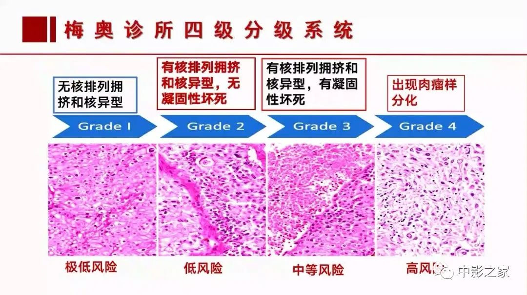 【PPT】肾嫌色细胞癌影像诊断、鉴别、分级与预后评估-53