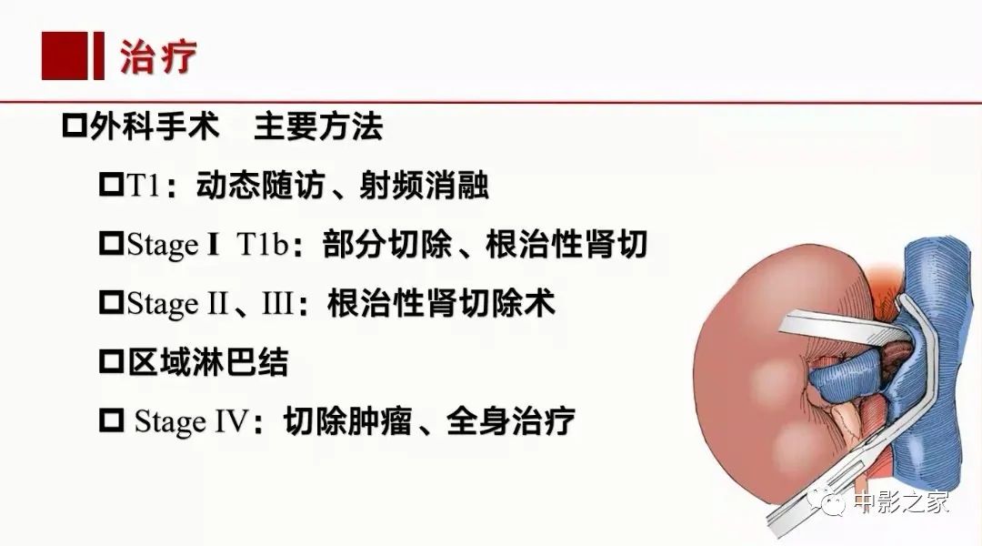 【PPT】肾嫌色细胞癌影像诊断、鉴别、分级与预后评估-50