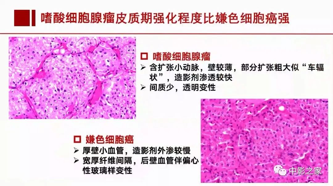 【PPT】肾嫌色细胞癌影像诊断、鉴别、分级与预后评估-41