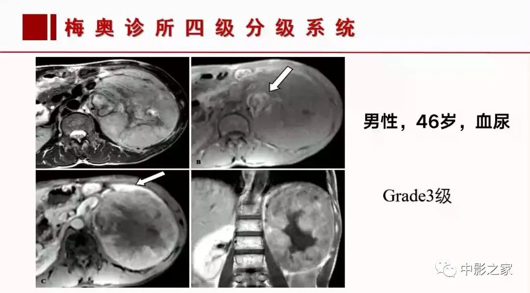 【PPT】肾嫌色细胞癌影像诊断、鉴别、分级与预后评估-55