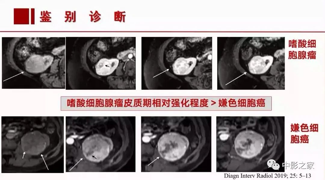【PPT】肾嫌色细胞癌影像诊断、鉴别、分级与预后评估-40