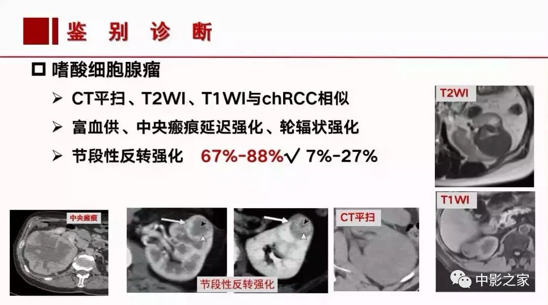【PPT】肾嫌色细胞癌影像诊断、鉴别、分级与预后评估-39