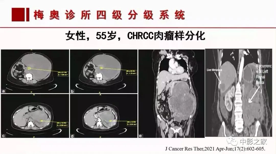 【PPT】肾嫌色细胞癌影像诊断、鉴别、分级与预后评估-54