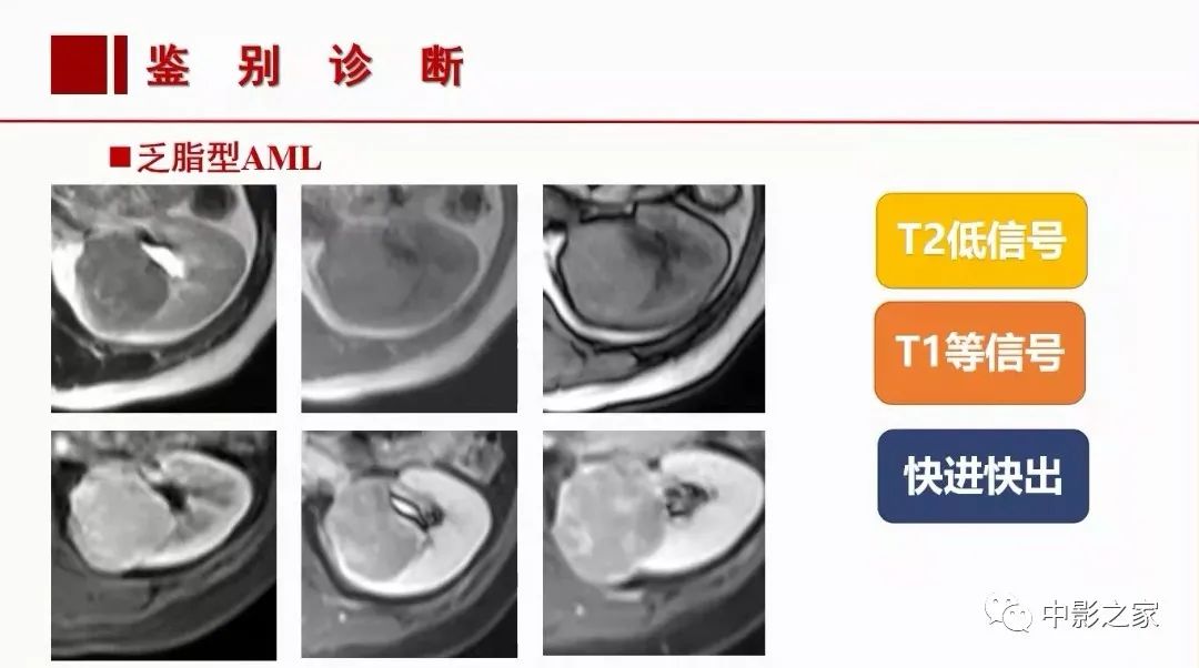 【PPT】肾嫌色细胞癌影像诊断、鉴别、分级与预后评估-38