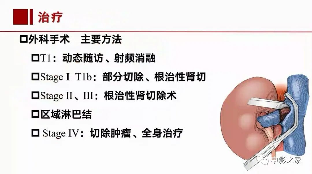 【PPT】肾嫌色细胞癌影像诊断、鉴别、分级与预后评估-48
