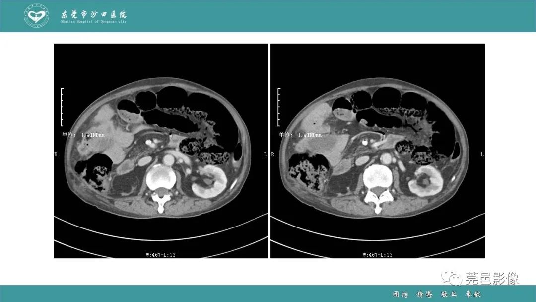 【PPT】1例肠缺血坏死伴门静脉积气的CT诊断-11