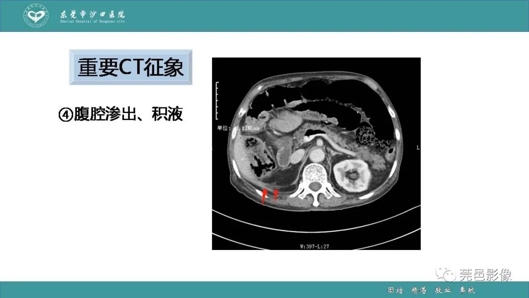 【PPT】1例肠缺血坏死伴门静脉积气的CT诊断-29