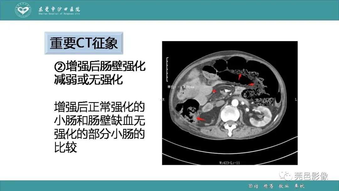 【PPT】1例肠缺血坏死伴门静脉积气的CT诊断-27