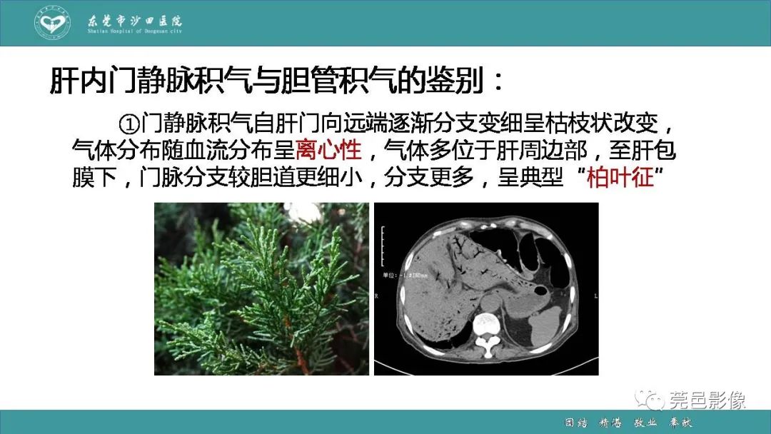 【PPT】1例肠缺血坏死伴门静脉积气的CT诊断-34