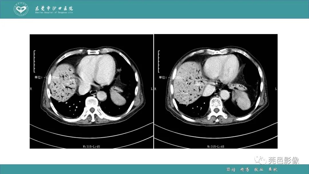 【PPT】1例肠缺血坏死伴门静脉积气的CT诊断-3