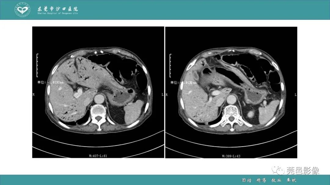 【PPT】1例肠缺血坏死伴门静脉积气的CT诊断-6