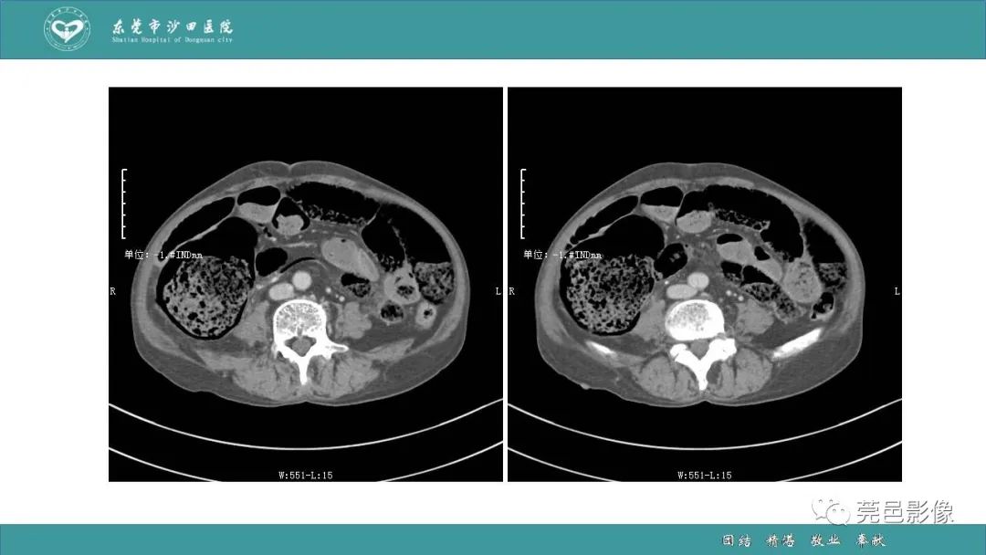【PPT】1例肠缺血坏死伴门静脉积气的CT诊断-16