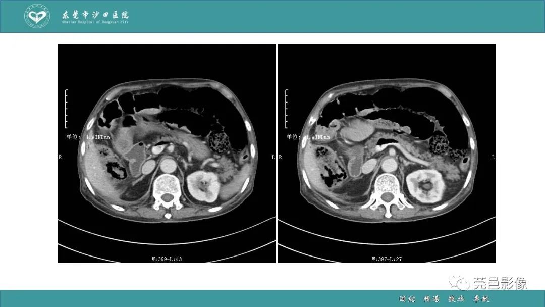 【PPT】1例肠缺血坏死伴门静脉积气的CT诊断-8