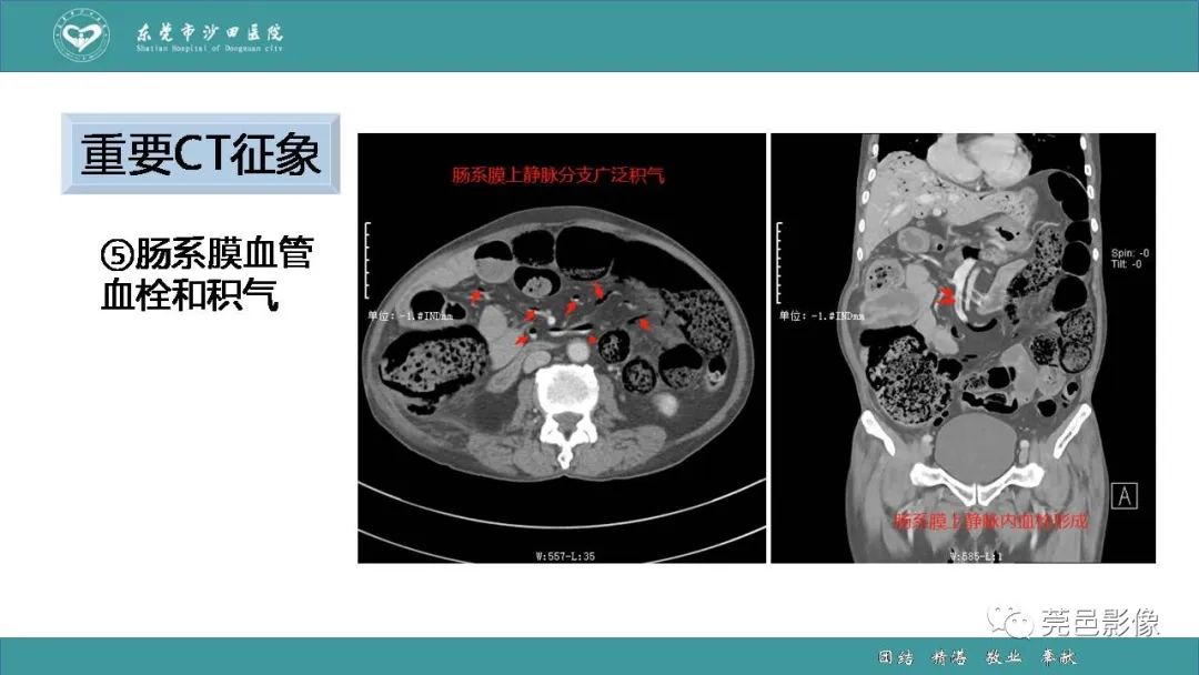 【PPT】1例肠缺血坏死伴门静脉积气的CT诊断-31