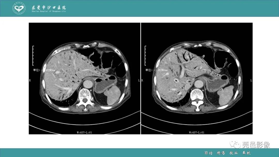 【PPT】1例肠缺血坏死伴门静脉积气的CT诊断-5