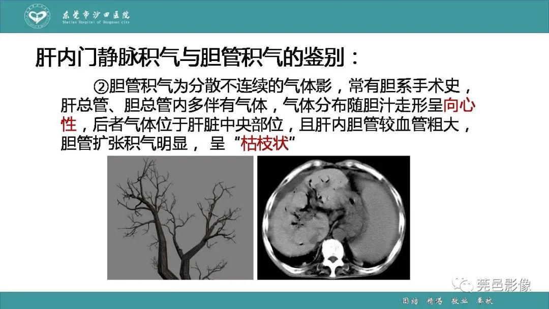【PPT】1例肠缺血坏死伴门静脉积气的CT诊断-35