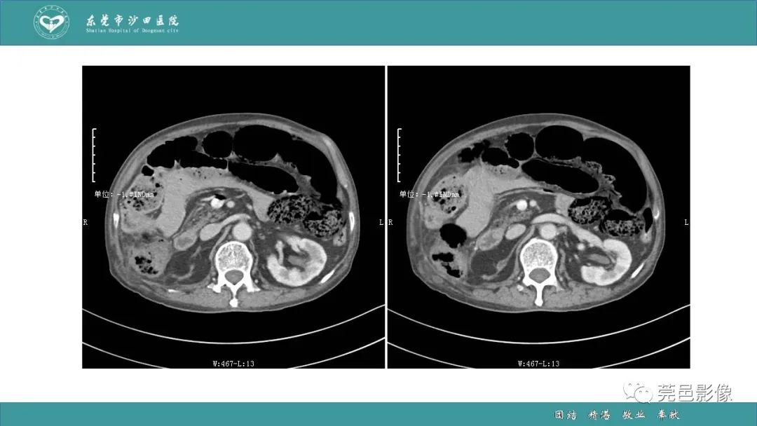 【PPT】1例肠缺血坏死伴门静脉积气的CT诊断-10