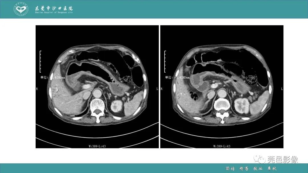 【PPT】1例肠缺血坏死伴门静脉积气的CT诊断-7