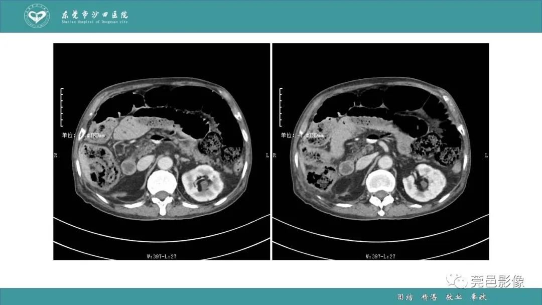 【PPT】1例肠缺血坏死伴门静脉积气的CT诊断-9