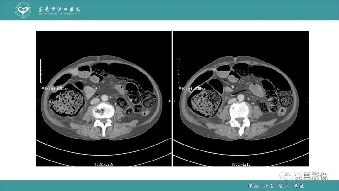 【PPT】1例肠缺血坏死伴门静脉积气的CT诊断-15
