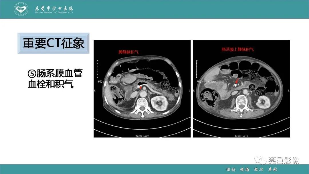 【PPT】1例肠缺血坏死伴门静脉积气的CT诊断-30