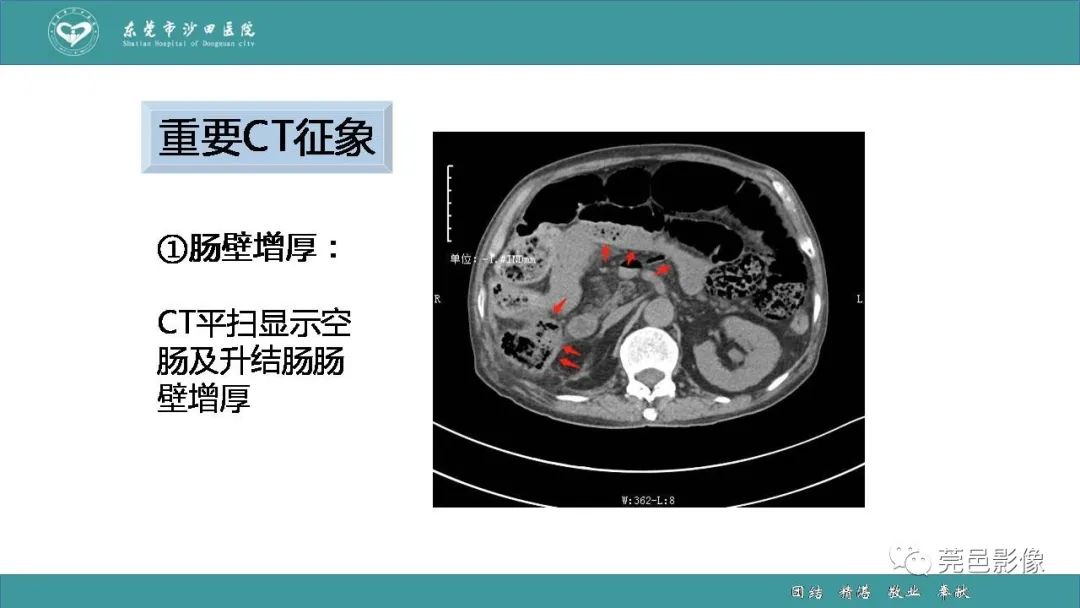 【PPT】1例肠缺血坏死伴门静脉积气的CT诊断-26