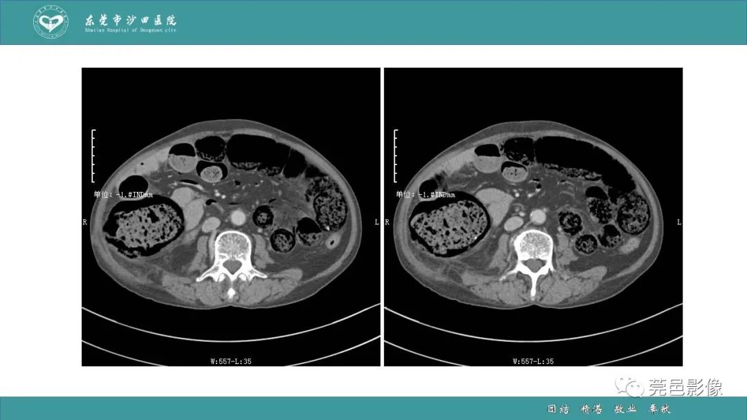 【PPT】1例肠缺血坏死伴门静脉积气的CT诊断-14