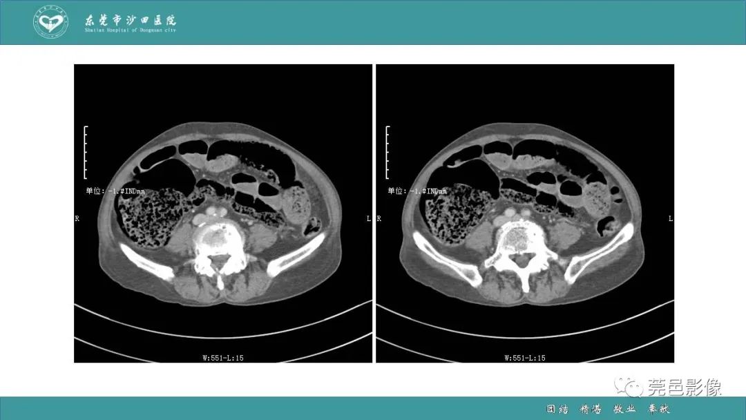 【PPT】1例肠缺血坏死伴门静脉积气的CT诊断-17