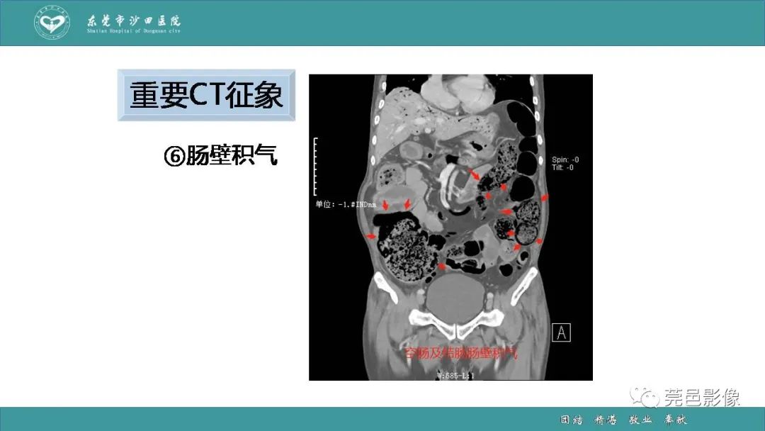 【PPT】1例肠缺血坏死伴门静脉积气的CT诊断-32