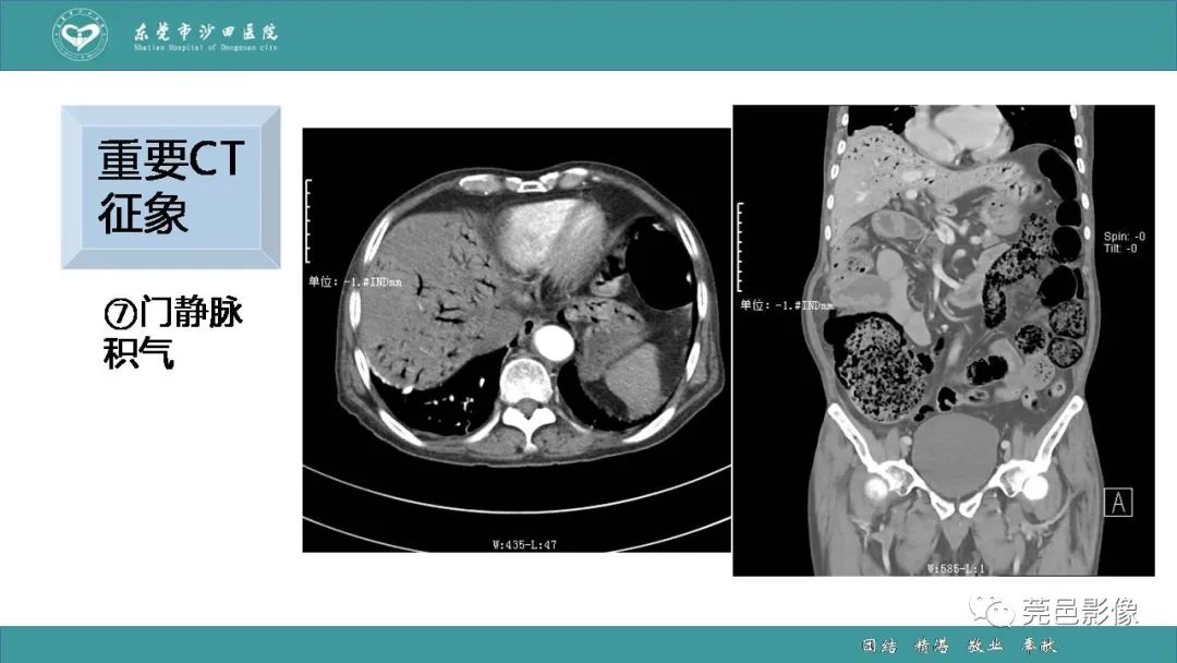 【PPT】1例肠缺血坏死伴门静脉积气的CT诊断-33