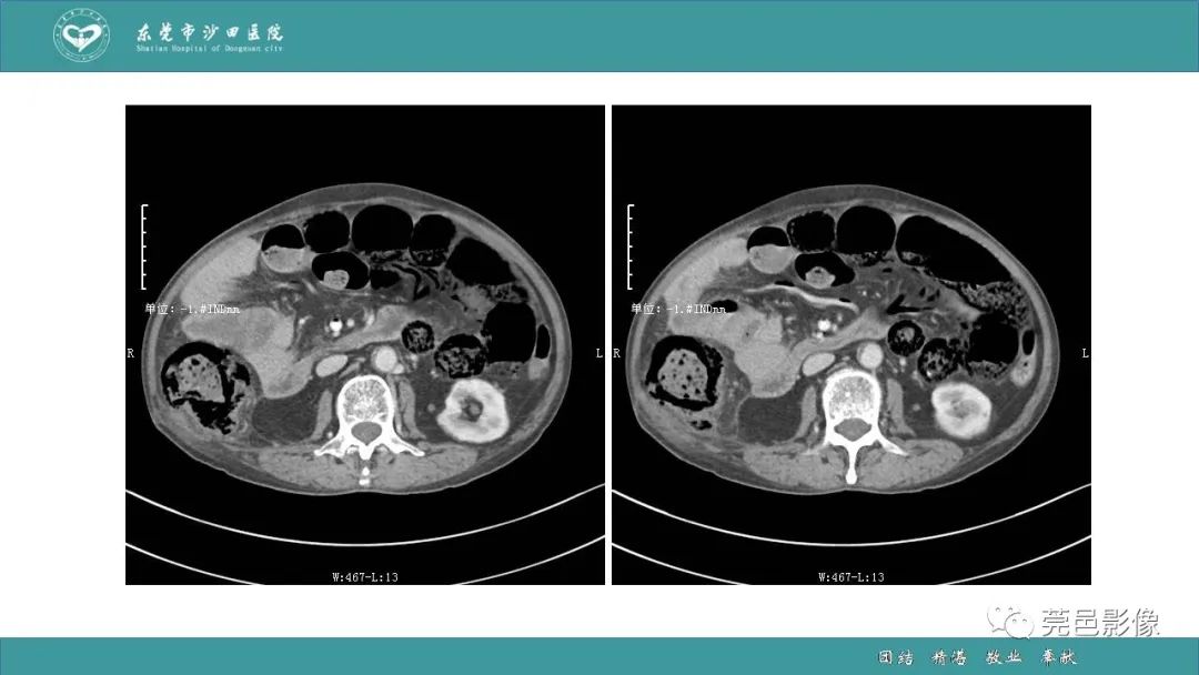 【PPT】1例肠缺血坏死伴门静脉积气的CT诊断-12