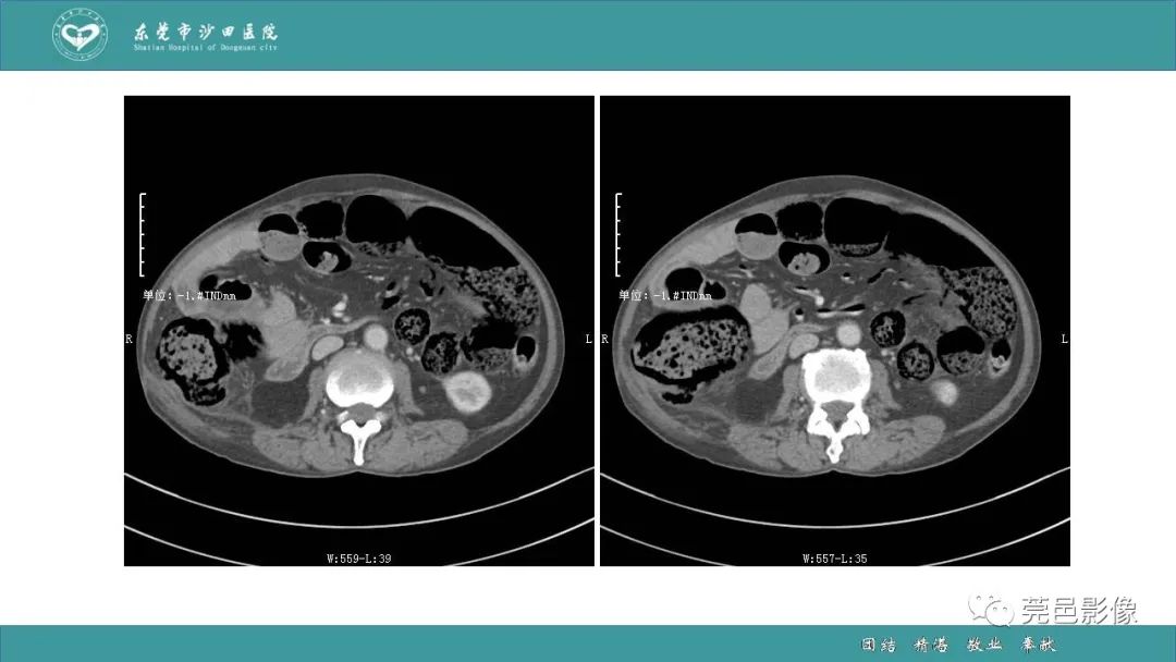 【PPT】1例肠缺血坏死伴门静脉积气的CT诊断-13