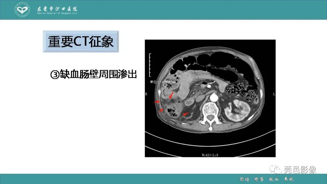 【PPT】1例肠缺血坏死伴门静脉积气的CT诊断-28