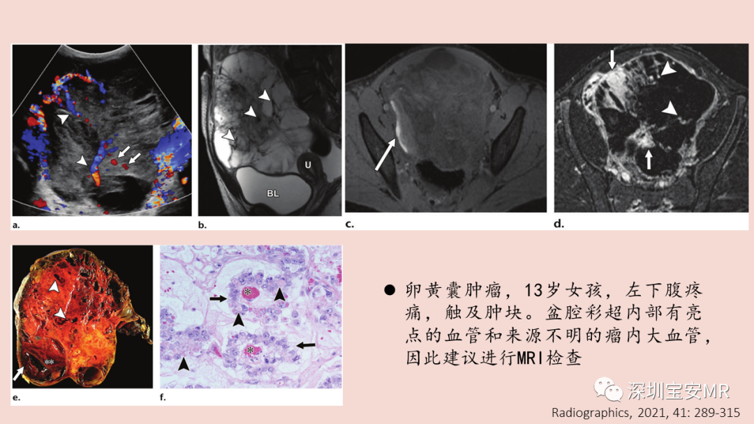 【PPT】卵巢交界性上皮性肿瘤MRI与病理对照-13